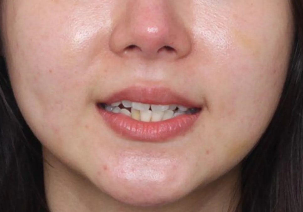 세라믹 치과, 삐뚤빼뚤한 치아를 교정 없이 라미네이트로 치료한 사례 관련 이미지 2