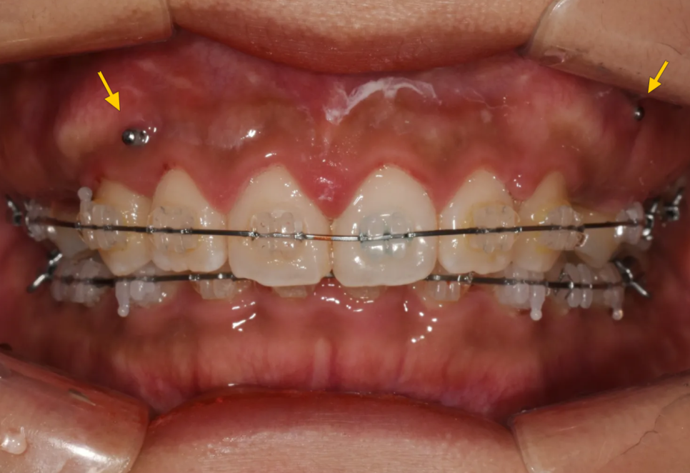 과개교합 교정: 비수술로 치료한 토끼 이빨 이야기 관련 이미지 7