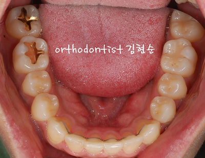 반대교합 관련 이미지 21