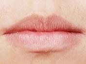 학동역 치아교정, 수술없이 예뻐져도 되나요? [돌출입교정 전후 달라진 외모] 관련 이미지 4