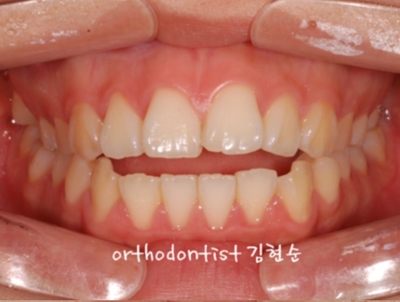 강남치아교정추천 관련 이미지 7