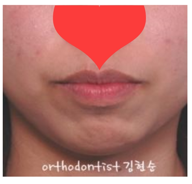 돌출입 교정으로 외모변화를 확인 관련 이미지 5