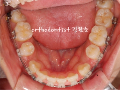 강남치아교정추천 관련 이미지 30