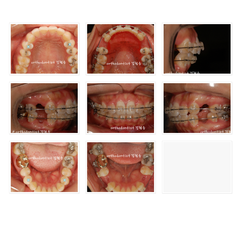 세라믹교정 세라믹치과-돌출입발치교정 7 관련 이미지 4