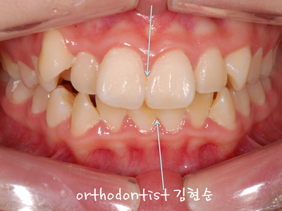 강남 돌출 (토끼 치아) 관련 이미지 5