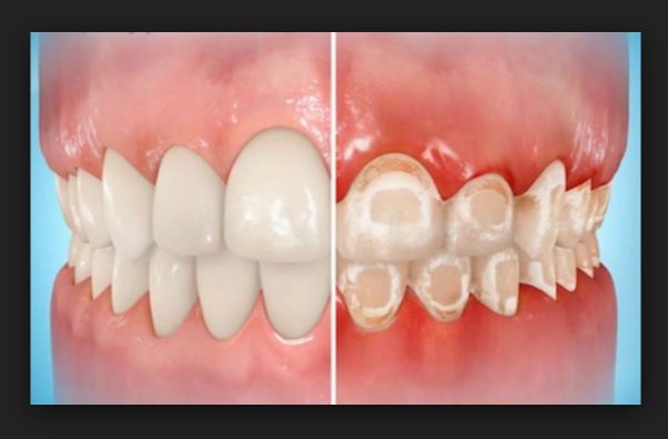 치아교정 부작용 탈회와 치아우식 관련 이미지 4