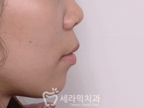 콤비교정 치아교정전후, 남몰래 제대로 교정하기! 관련 이미지 4