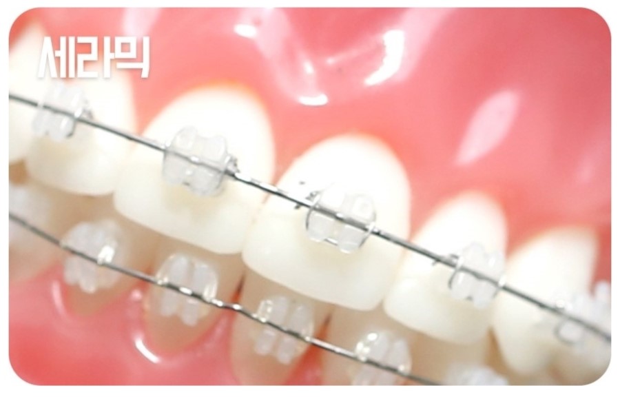 세라믹교정 클리피씨 데이몬 차이점 요약 관련 이미지 11