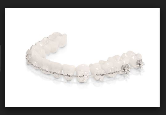 치아교정 부작용 세라믹교정 관련 이미지 4