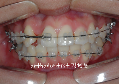 강남 돌출 관련 이미지 13