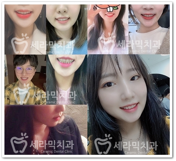 과개교합 치아교정전후, 얼마나 달라졌을까? 관련 이미지 3