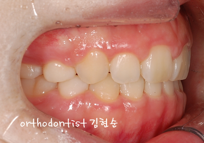 강남 돌출 관련 이미지 30