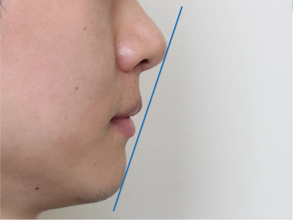 돌출입 재교정, 그것도 세 번째. 관련 이미지 10