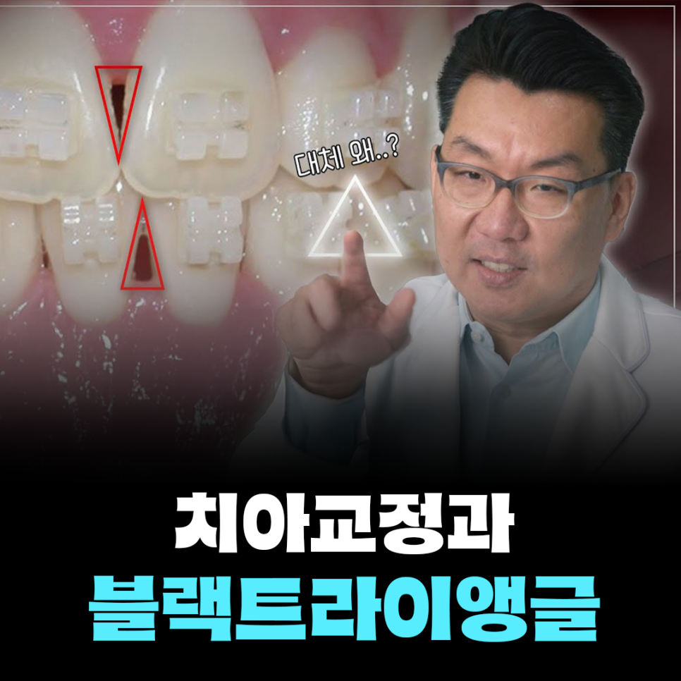 &lsquo;블랙트라이앵글&rsquo;에서 벗어나고 싶다면? (feat. 잇몸관리방법) 관련 이미지 1