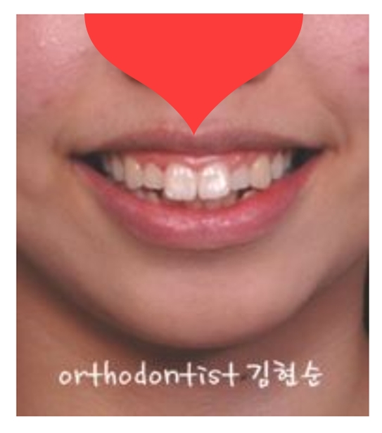 돌출입 교정으로 외모변화를 확인 관련 이미지 6