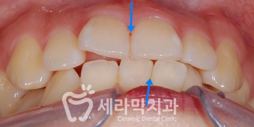 돌출입과 과개교합, 중심선 불일치, 치열불규칙 치아교정전후사진 관련 이미지 2