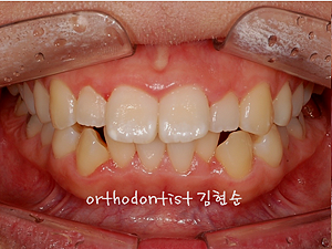 강남 돌출입 교정 관련 이미지 12
