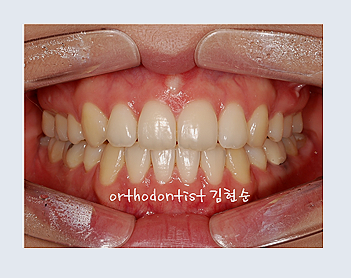 강남교정치과 관련 이미지 12