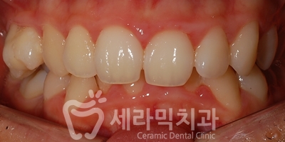 과개교합 치아교정잘하는곳, 세라믹치과 치아교정전후! 관련 이미지 4