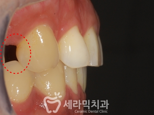 벌어진치아 투명교정 치아교정전후 관련 이미지 2