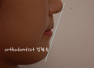 치열 교정(치열 불규칙) 관련 이미지 32