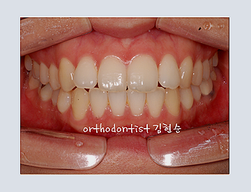 강남교정치과 관련 이미지 10