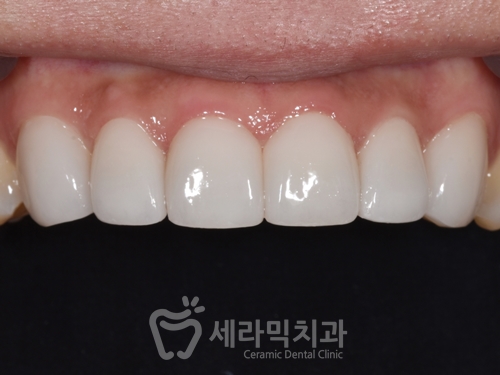 강남라미네이트치과 세라네이트 전후 사례 - 달라진 스마일라인 관련 이미지 5