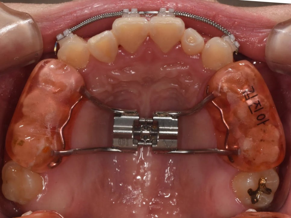 언주역 치과, 주걱턱 + 과개교합을 비수술로 치료한 사례 관련 이미지 6