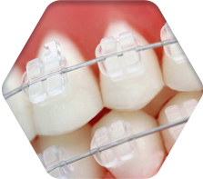 세라믹교정 세라믹치과  "투명교정"의 새이름 "3D미소교정" 관련 이미지 7