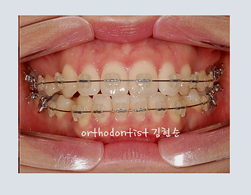 강남교정치과 관련 이미지 11