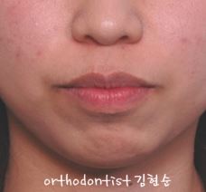 세라믹치과 "돌출입 발치교정" 관련 이미지 3