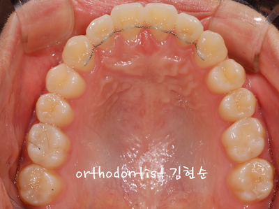 반대 교합 관련 이미지 28