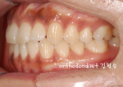 치열 교정 ( 벌어짐 ) 관련 이미지 10