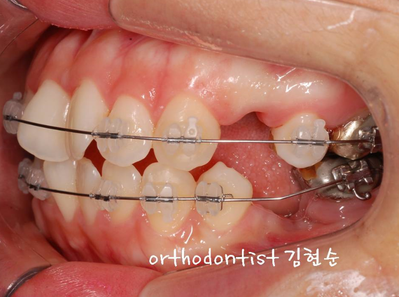 강남 돌출입 교정 관련 이미지 14