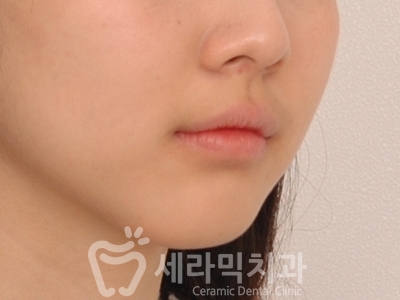 과개교합 치아교정잘하는곳, 세라믹치과 치아교정전후! 관련 이미지 10