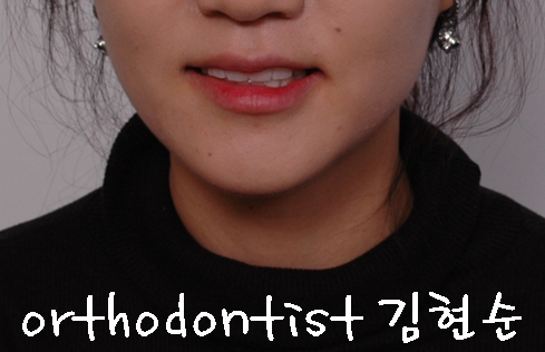 강남 덧니 관련 이미지 27