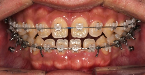 치아가 반대로 물리는 관련 이미지 9