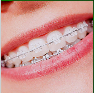 강남 세라믹 교정 관련 이미지 8