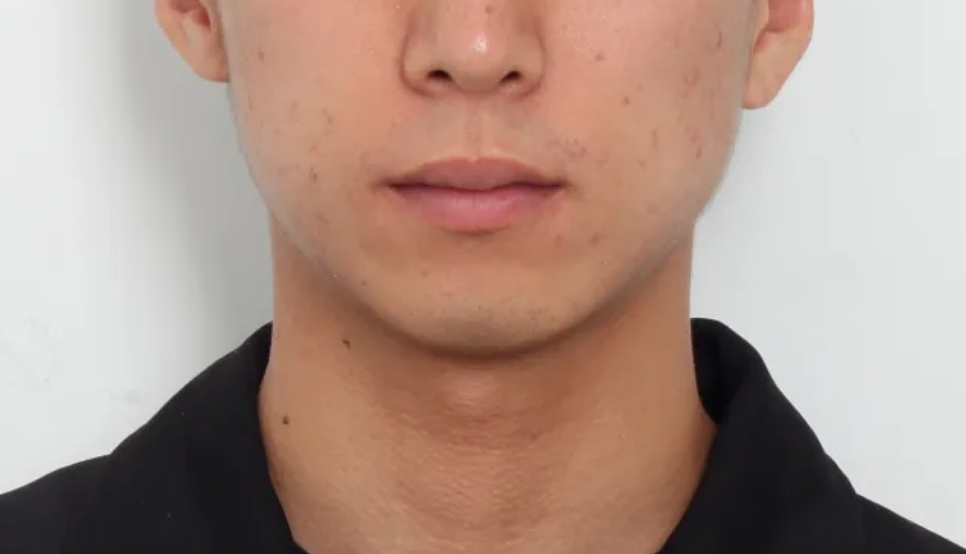 돌출입 교정 전후, 그런데 과개교합까지 있으셨던 환자분 관련 이미지 21