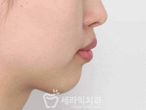 치아교정전후. 돌출입교정으로 갸름한 입술을 얻다! 관련 이미지 1
