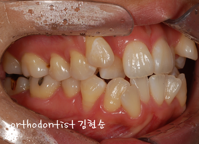 강남 덧니 관련 이미지 9