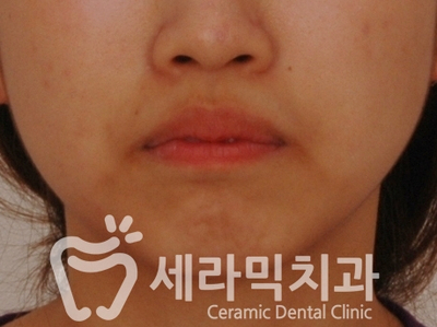 치아교정 전후 스마일라인 변화!(돌출입,토끼앞니, 중심선 비대칭 동시 교정) 관련 이미지 3