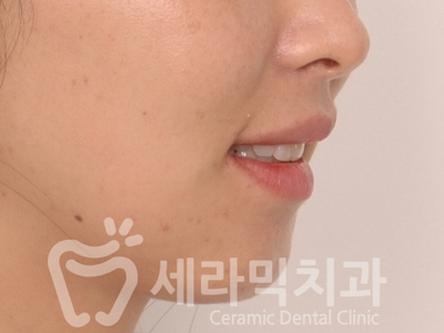 무턱교정, 거미스마일 교정 잘하는 학동역 세라믹치과 관련 이미지 8