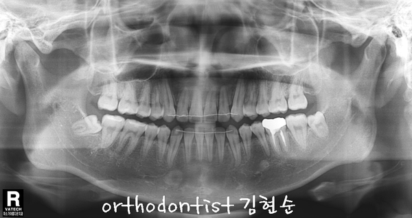 반대 교합 관련 이미지 34