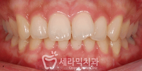 앞니 돌출입과 과개교합 치아교정전후 자신감 넘치는 미소! 관련 이미지 2