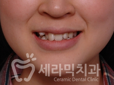 덧니 세라믹교정 전후사진, 학동역 세라믹치과 관련 이미지 2