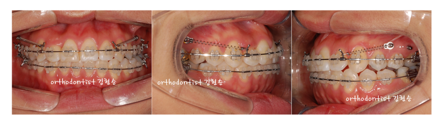 안면비대칭 교정, 치아교정만으로 간단히 해결하기 관련 이미지 12