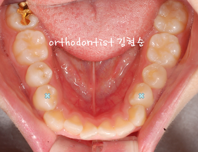 강남 돌출 관련 이미지 15