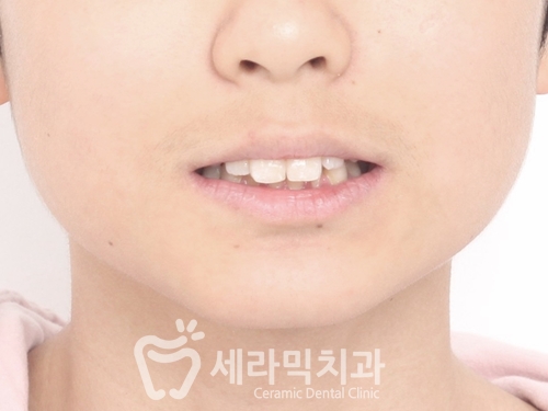 청소년교정 10대교정 딥바이트 과개교합 치아교정전후 관련 이미지 3