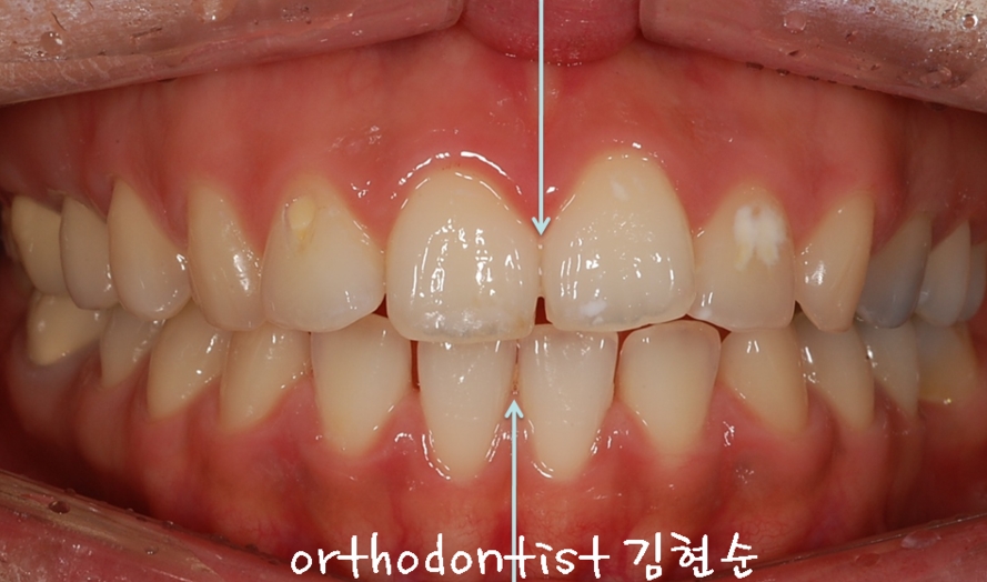 세라믹교정 은 세라믹치과 돌출입교정 관련 이미지 5